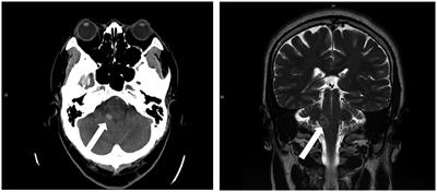 Adrenal insufficiency following cerebellar intracranial hemorrhage: a case report